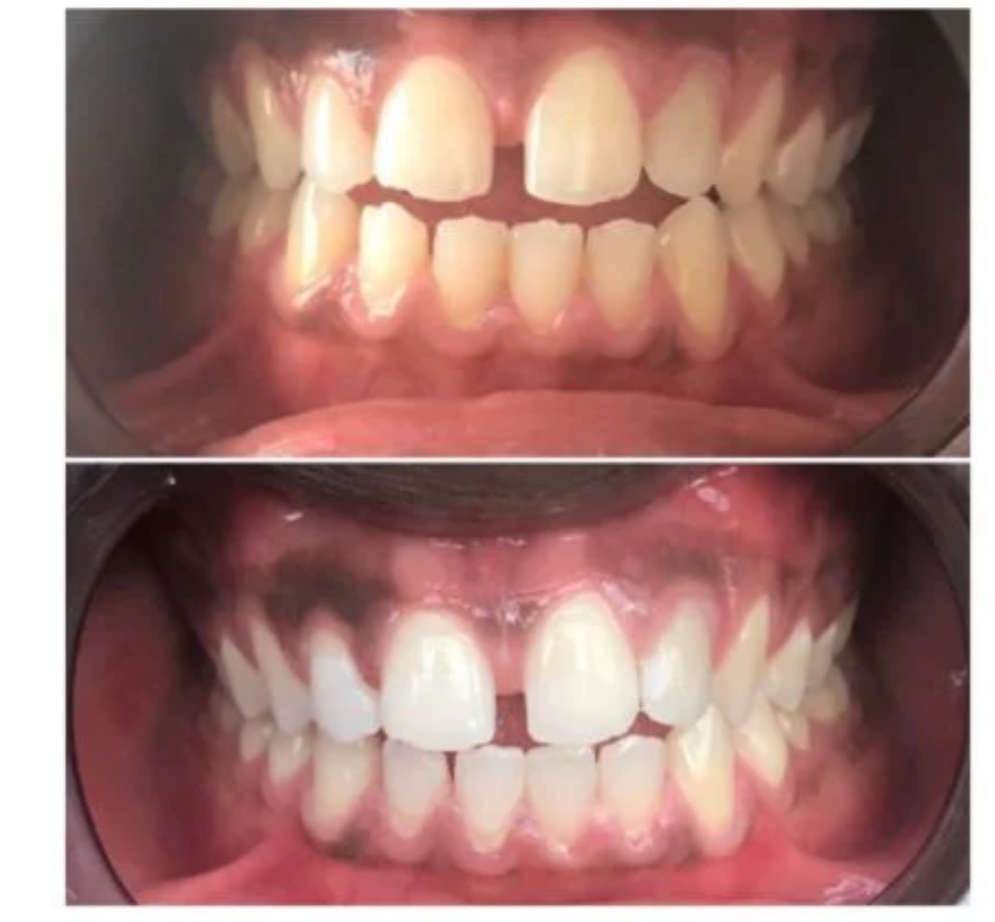 Dentifrice blanchissant à l'Aloe vera (format voyage) | Enrichi en Propolis et Xylitol