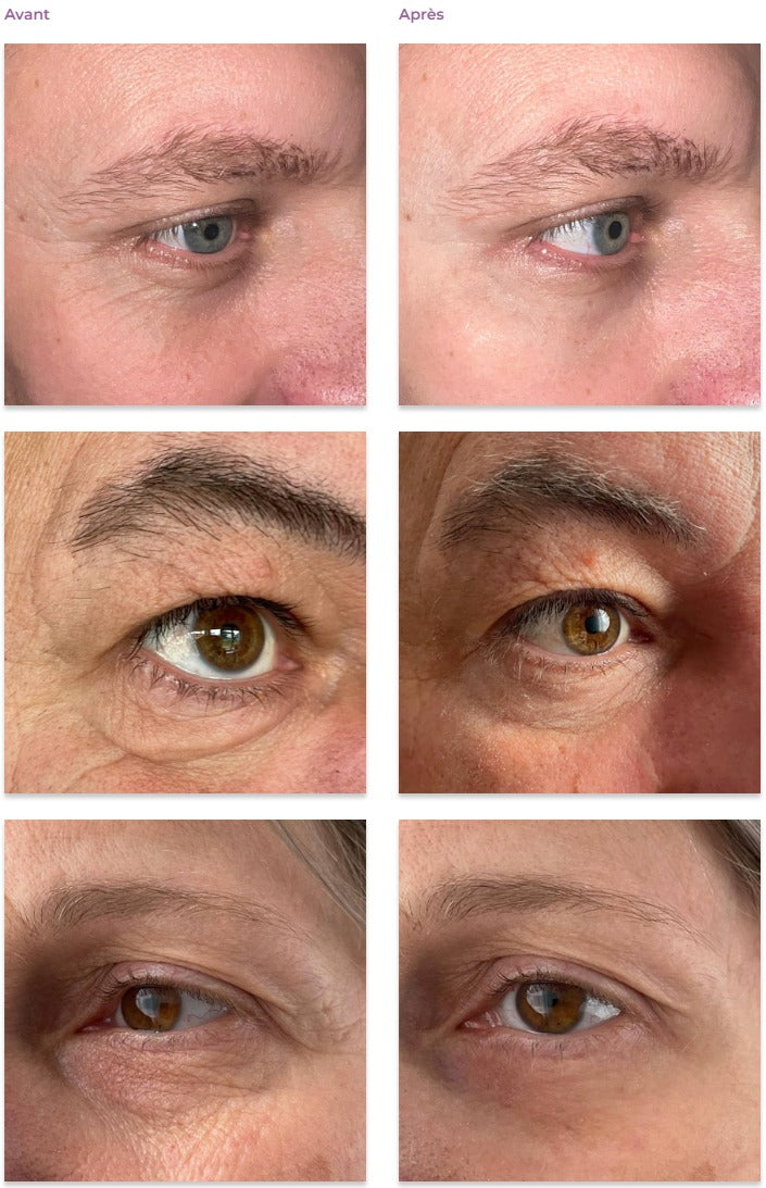 Crème anti-rides pour les yeux à effet « shock action » avec LIPHASYN™-20 ml